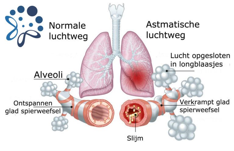 zoutkamer Astma